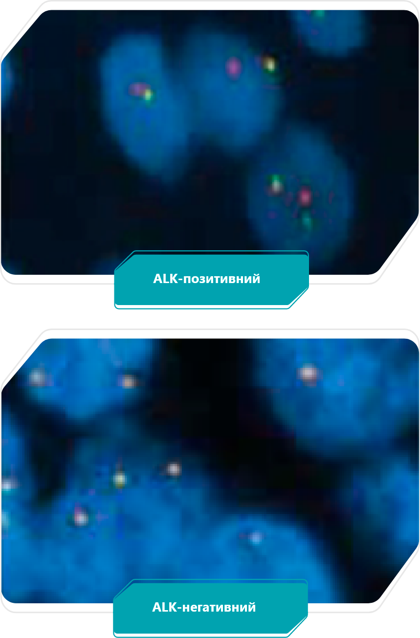 ALK-тестування методом FISH